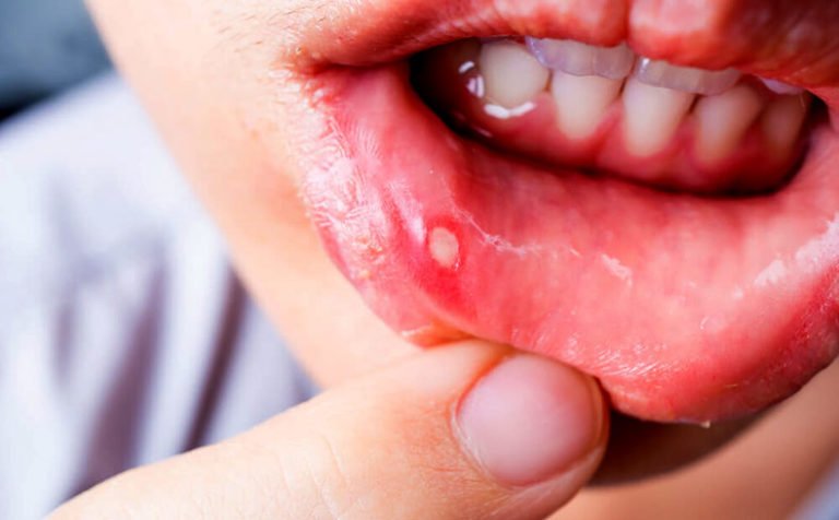 know-about-mouth-ulcer-its-causes-and-remedies-bigumbrella